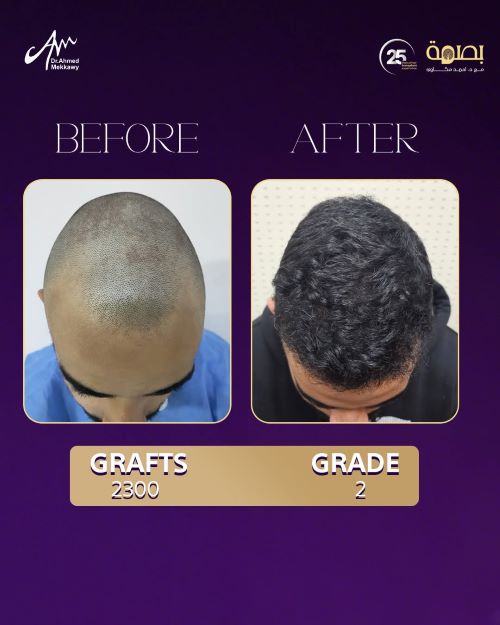 دكتور زراعة شعر 2026
